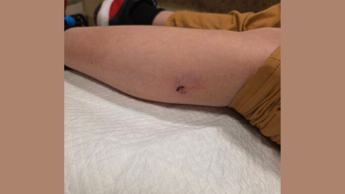 11-year-old bitten by dog Redmond